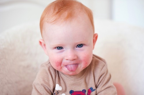 Baby with Eczema